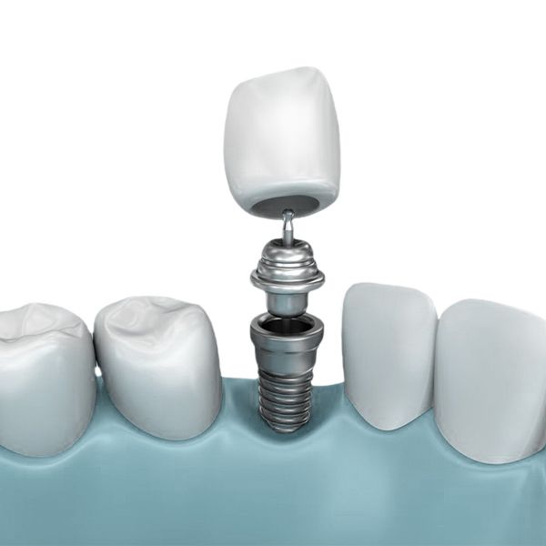 An illustration of a dental implant-supported crown
