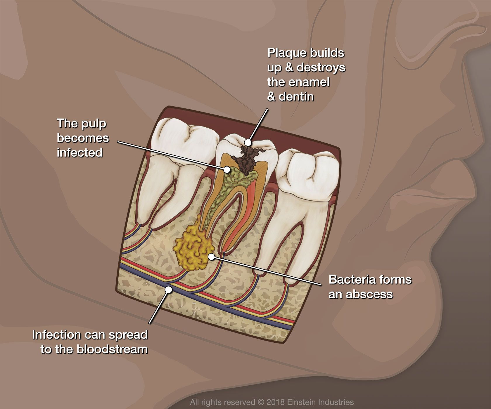 An illustration of a root canal infection and how it affects oral health